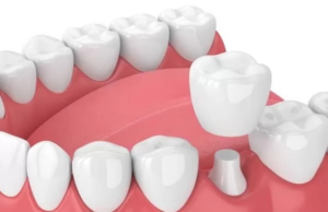 Zirconia Teeth Crowns: Advantages, Cost and More聽